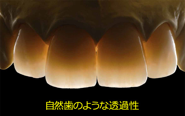 自然歯のような透過性のIPS e.max プレスにご期待ください。