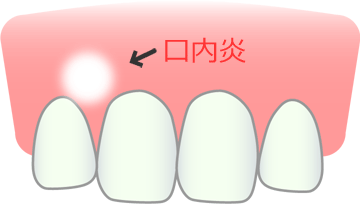 口内炎の治療