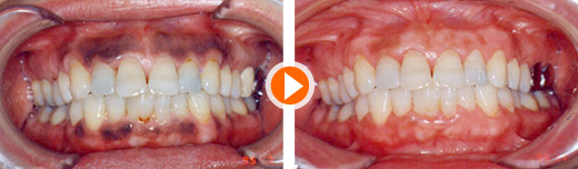 ガムブリーチング - 歯ぐきのホワイトニング・歯ぐきの黒ずみ除去