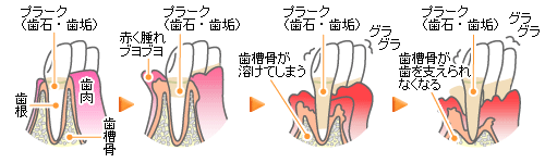 歯周病の進行