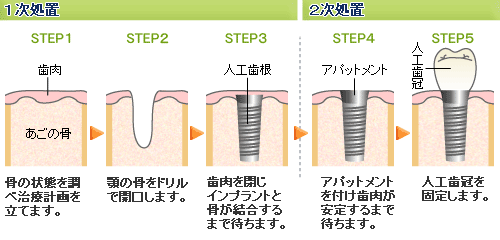 インプラントの治療手順