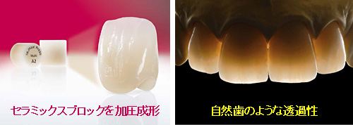 加圧成形によって製作するIPS e.max プレスは比較的低価格、それでいて自然歯のような透過性