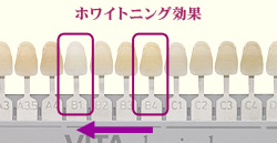 ホームホワイトニングの効果