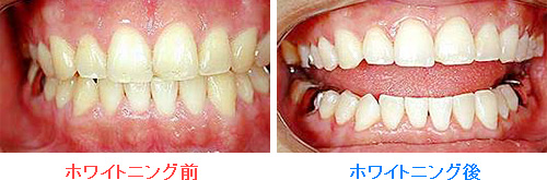 ホームホワイトニングの治療例
