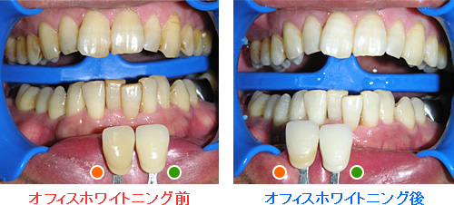 治療例１：ホワイトニング前とホワイトニング後