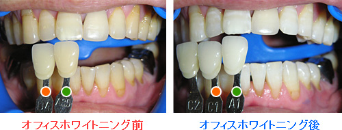 治療例２：ホワイトニング前とホワイトニング後