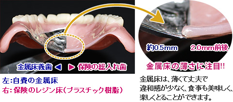 自費の金属床義歯と保険のレジン床義歯の比較