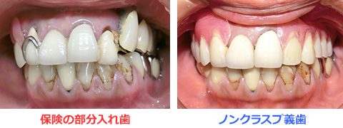 自費の金属床義歯と保険のレジン床義歯の比較
