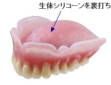 生体シリコーンを裏打ちした快適な入れ歯