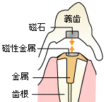 磁性アタッチメント義歯