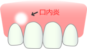 口内炎の治療