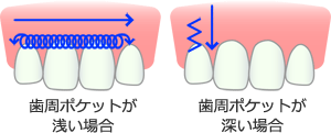 歯肉の急性炎症緩和。歯周病の治療など。