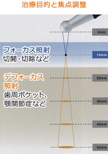 治療目的に応じてレーザー光を焦点調整