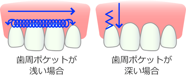 歯肉の急性炎症緩和。歯周病の治療など。