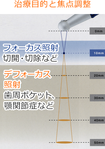 治療目的に応じてレーザー光を焦点調整