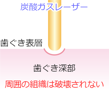 炭酸ガスレーザーの歯肉侵襲範囲